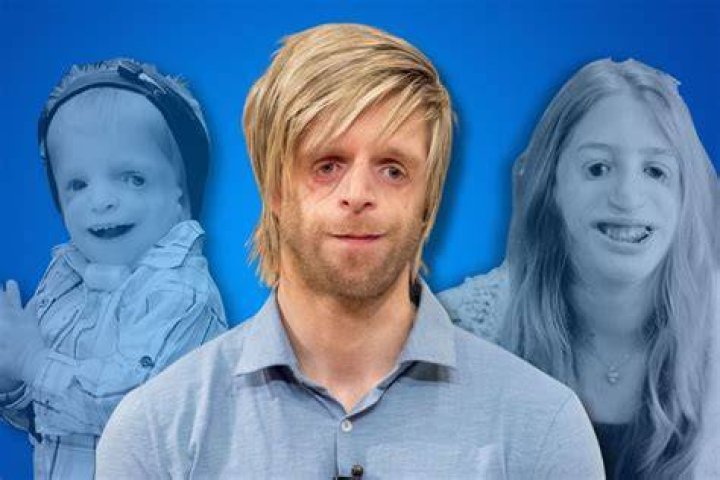 Celebrities With Treacher Collins Syndrome: Real Stories Of Triumph