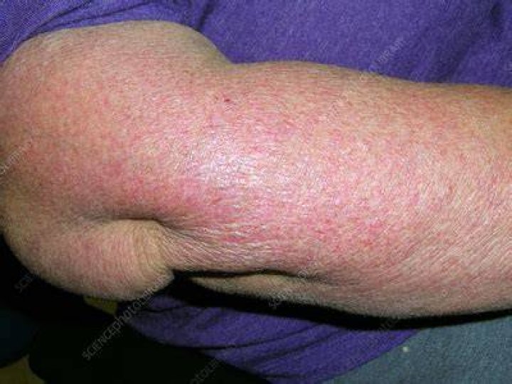 Dermatomyositis Flare Up Symptoms An identifying factor for