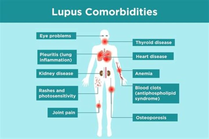 Understand Ozempic's Impact On Lupus: A Comprehensive Exploration