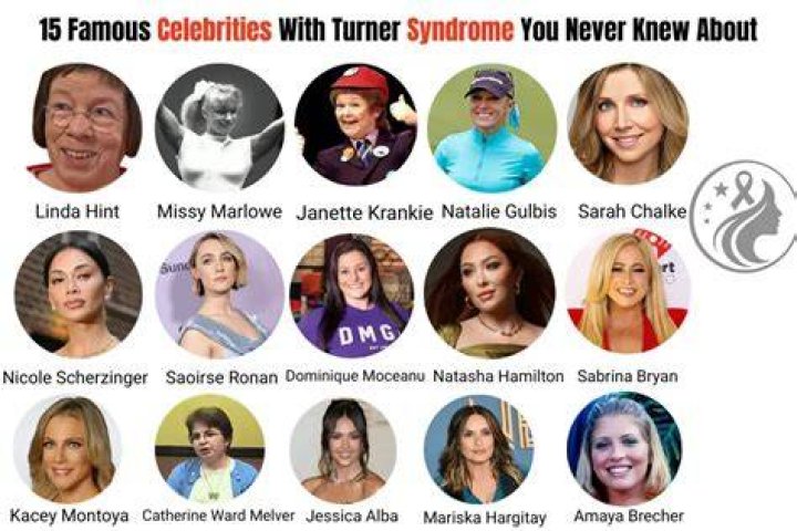 Unveiling The Extraordinary: Celebrities With Turner Syndrome